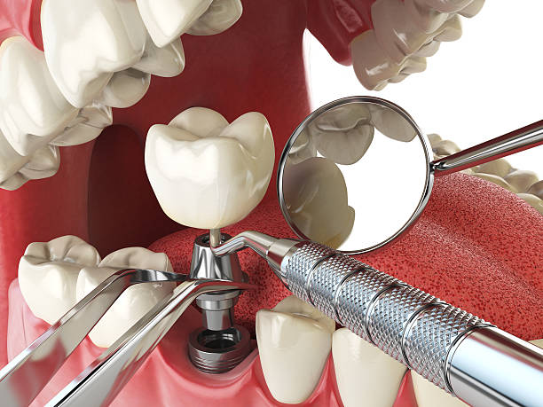 Best Emergency Dental Extractions in Los Altos, CA